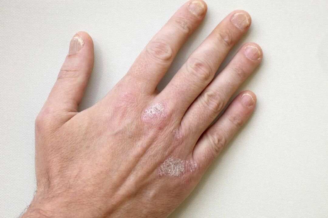 Psoriasis on a man's hands Treatment with Keramin cream