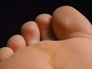 Causes of Plantar farm