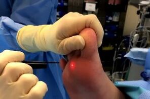 Surgical methods for removing warts