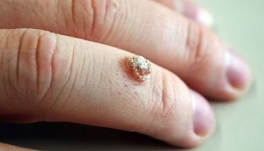 Methods for the treatment of warts with Celandine
