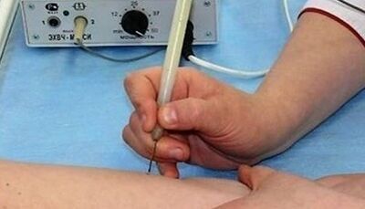 How to get rid of papillomas on your body