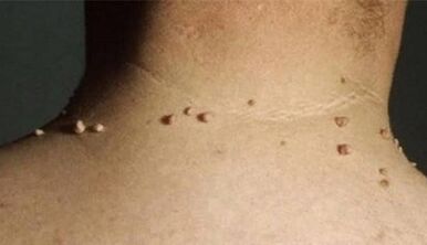 The reasons for the occurrence of papillomas on the human body