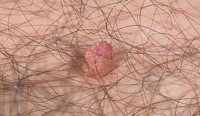 Opportunities to transfer the human papilloma virus
