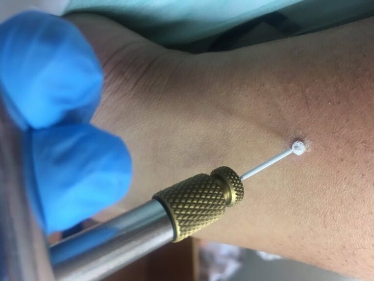 Ways to remove warts