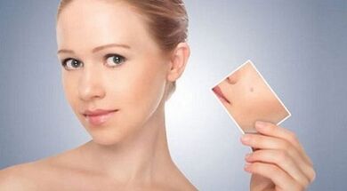 Review of effective remedies for warts and papillomas