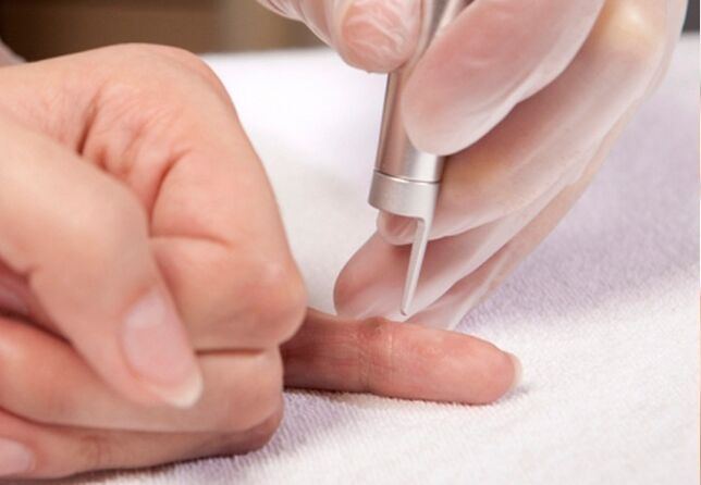 Removal of warts on fingers