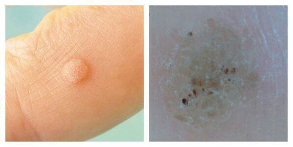 Ordinary warts during the examination and dermatoscopy