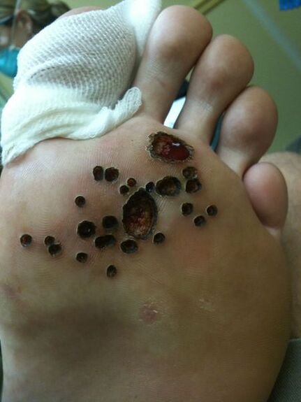 Skin after laser removal of warts on the leg
