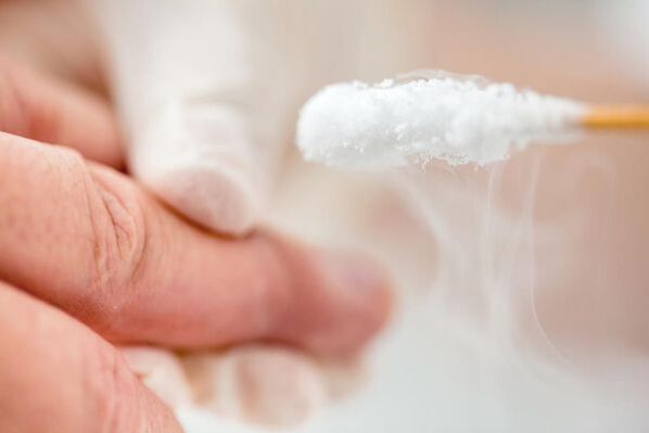 Treatment of warts with liquid nitrogen