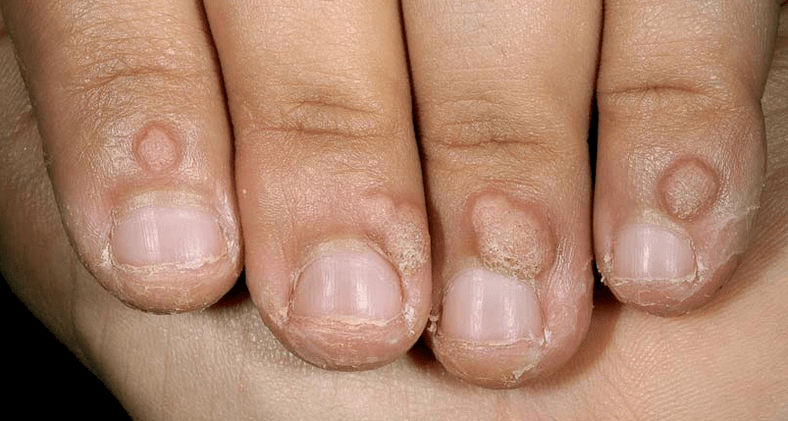 Wart