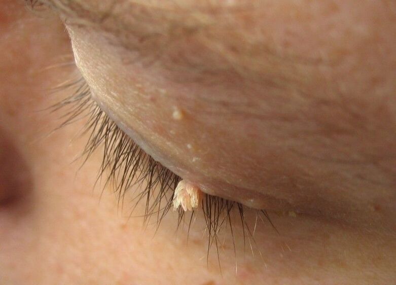 Warts from our eyes