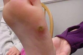 Warts on the hands