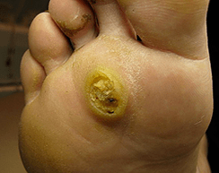 Subanary papillomas